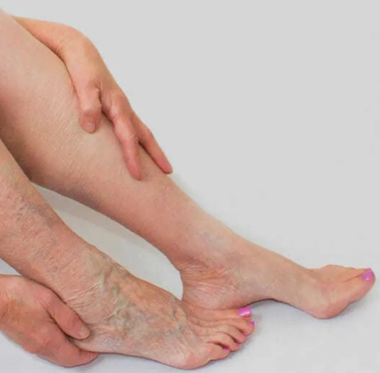 Tratamiento para Varices – Mejora Circulación en Piernas