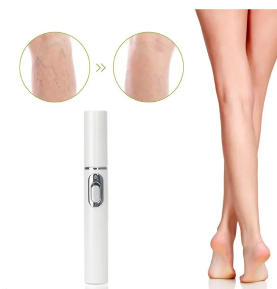 Tratamiento para Varices – Mejora Circulación en Piernas